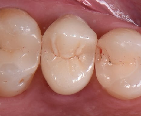 3MOCSD_Blog_Round13_Arcara_RelyXUniversal_560x460_11