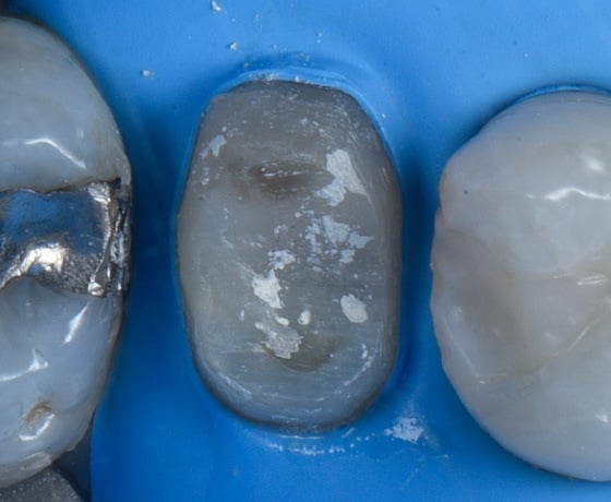 3MOCSD_Blog_Round13_Arcara_RelyXUniversal_560x460_3