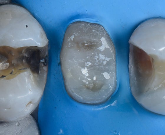 3MOCSD_Blog_Round13_Arcara_RelyXUniversal_560x460_4